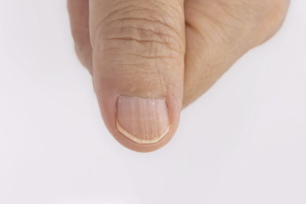 l trattamento delle macchie bianche sulle unghie deve essere mirato alla causa sottostante. L’integrazione nutrizionale